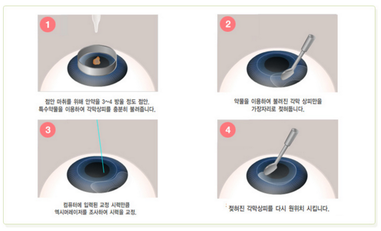 라섹-수술