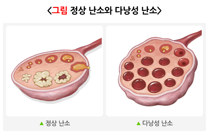 다낭성 난소 증후군(Polycystic ovary syndrome) 정의 원인 증상 진단 치료방법 청소년기 여아 임신 가능 여부