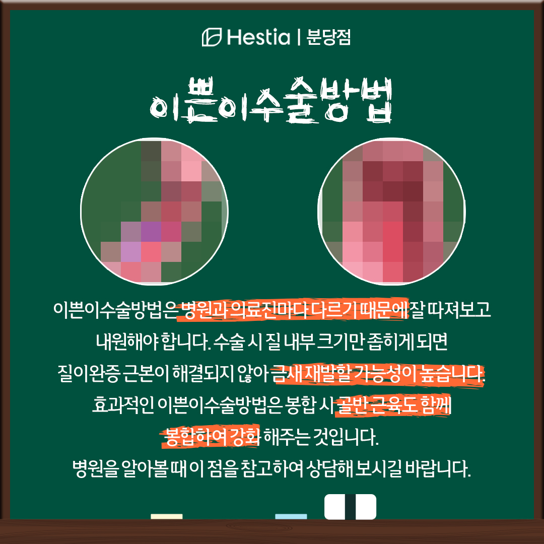 이쁜이수술방법 비용 질타이트닝가격 질방귀 안나오게 이쁜이수술방법 이란?