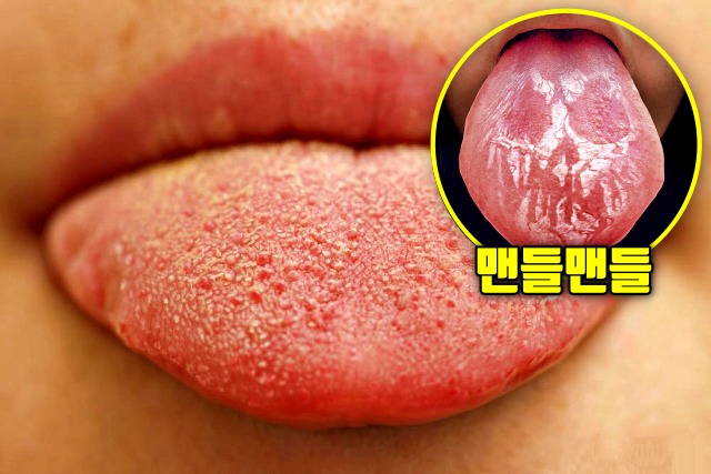 혀가 반들반들 비타민b12 철분 결핍 증상 설유두
