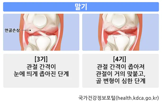 무릎관절염-말기-이미지