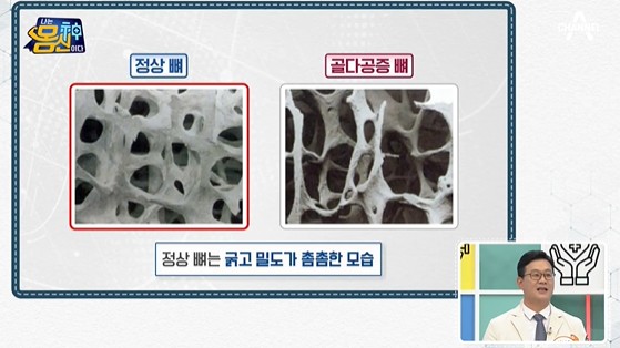 골다공증뼈