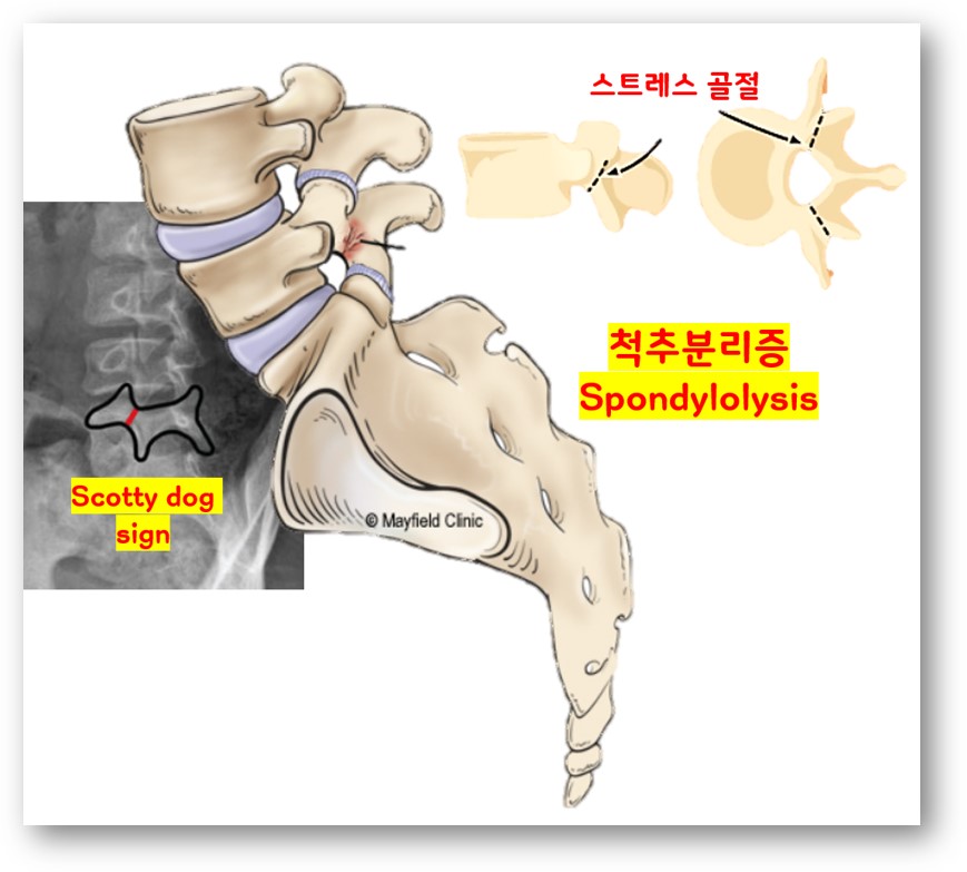 척추분리증 Scotty dog sign