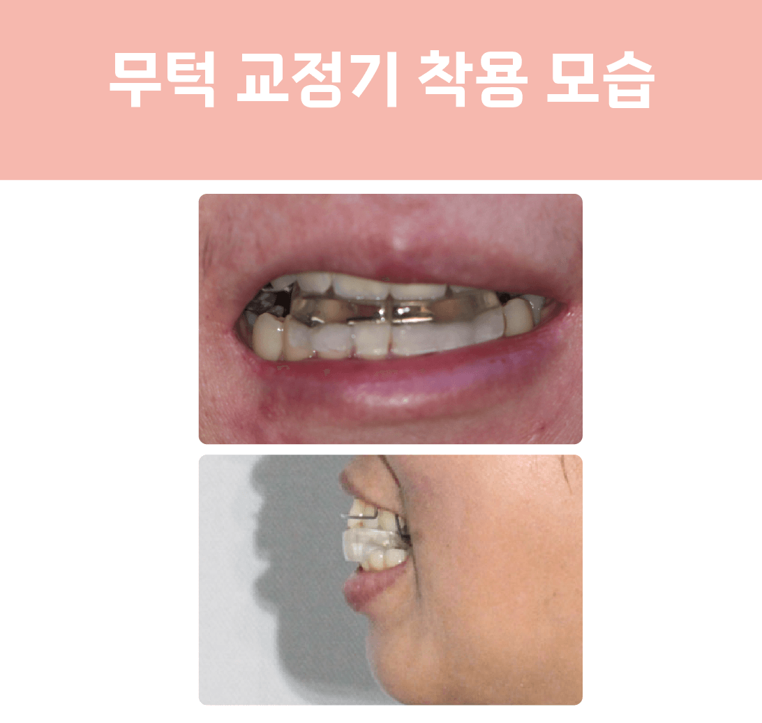 무턱-교정-장치-착용-모습