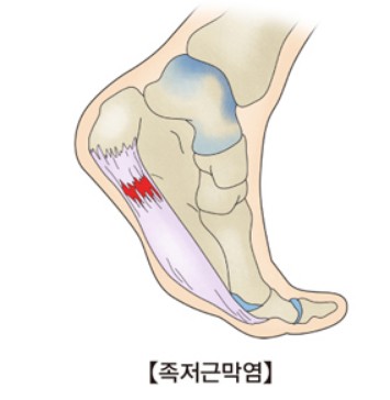 족저근막염 정의