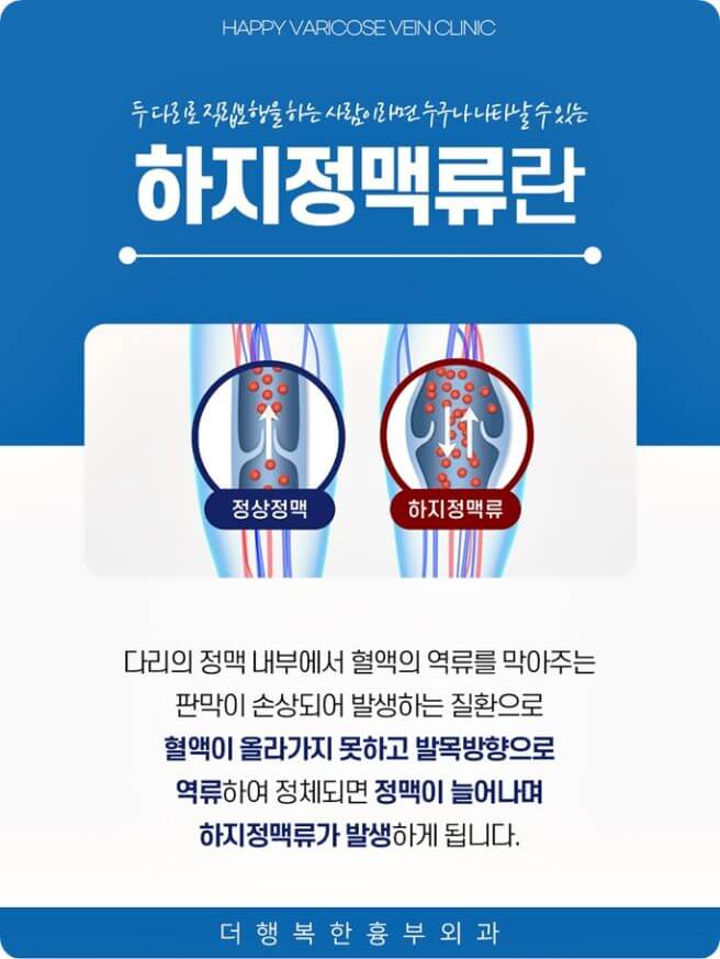 하지 정맥류 증상&amp;#44; 원인