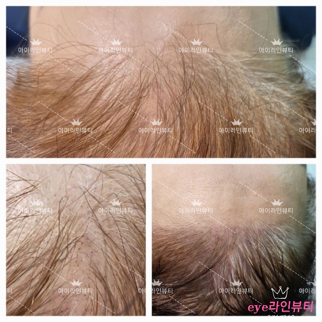  전주두피문신 주변에서 추천