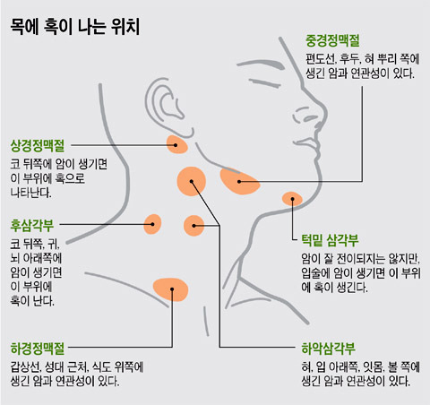 귀밑 멍울, 턱밑 멍울 - 목에 혹이 나는 위치