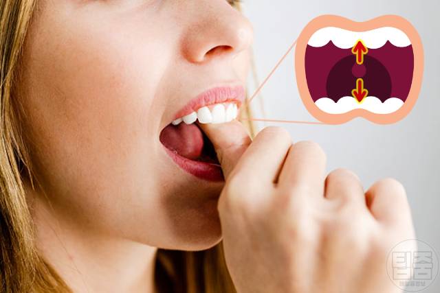 치매 안걸리는 방법 뇌위축 치매예방 혀운동 효과