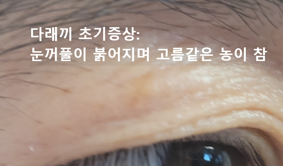 다래끼 초기증상 대응 방법 및 재발 방지 경험담