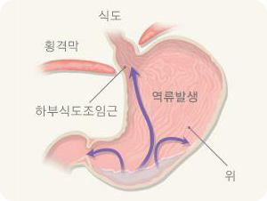 역류성식도염 사진