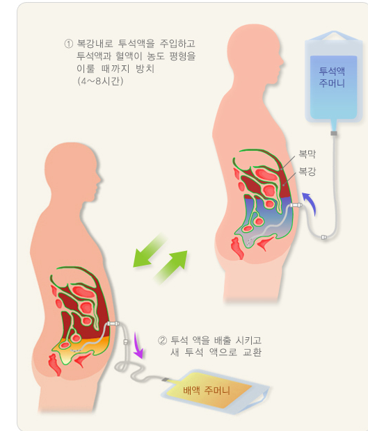 투석