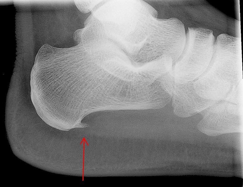 족저근막염이 심해지는 경우 종골에 spur가 발생할 수 있음을 보여주는 x-ray 사진