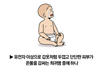 콜로디온 베이비 원인 완치 성인 등 소개(25년 ver)