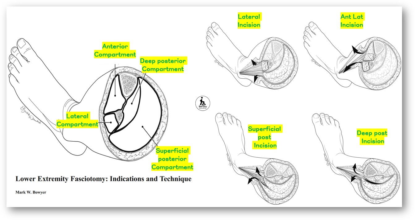 근막절개술 Fasciotomy