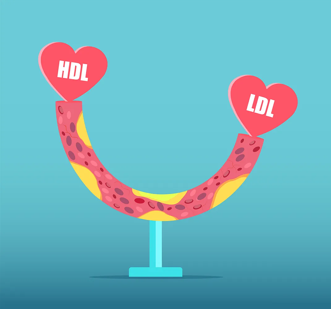 HDL-LDL-불균형-경화성-플라크가-있는-혈관