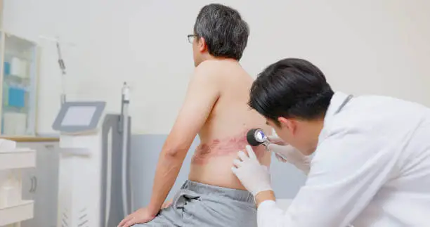 대상포진 초기증상