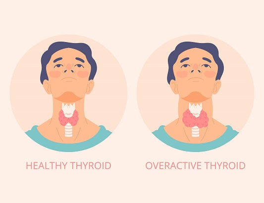 Undifferentiated-thyroid-cancer
