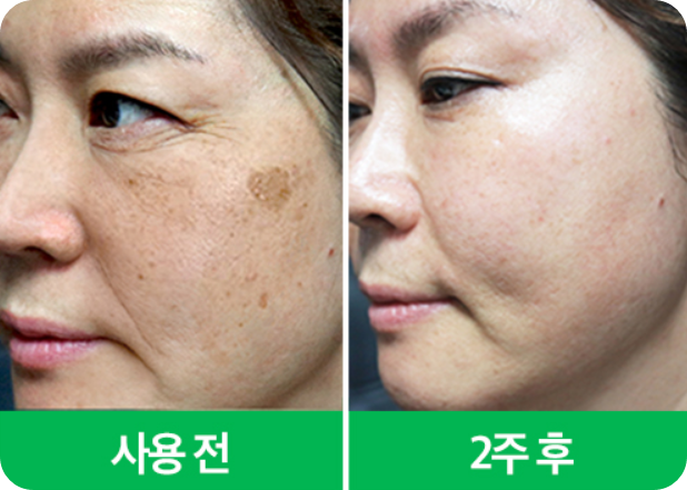 검버섯 제거