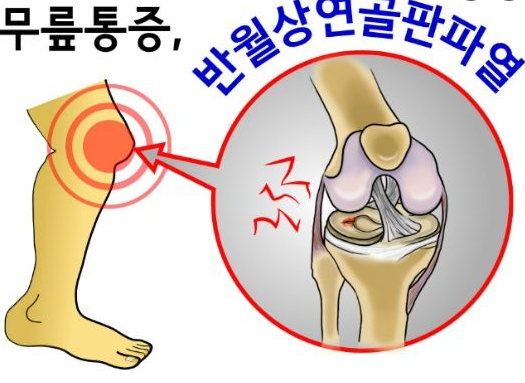 무릎에서 뚝 소리나는 이유