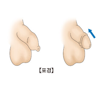 포경수술