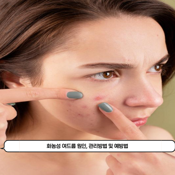  화농성 여드름의 원인, 관리방법 및 예방법 그리고 화농성 여드름에 좋은 음식