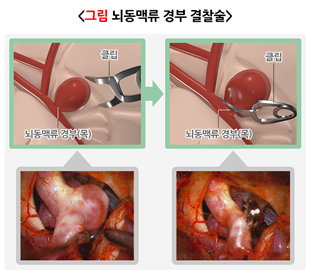 뇌동맥류-경부-결찰술