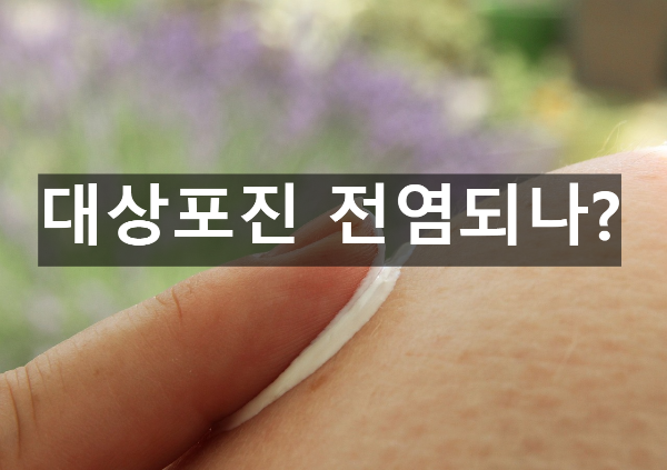  대상포진 전염되나?