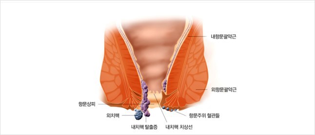  부끄러워도 꼭 치료해야 한다. 이름하여 그 이름 "치질"