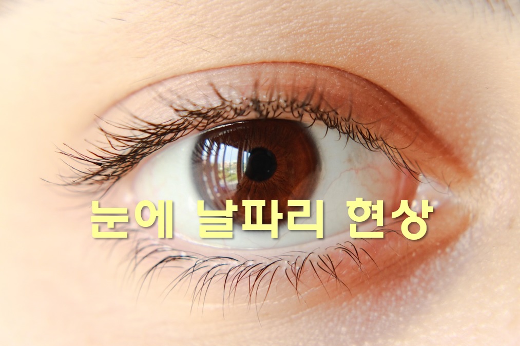  눈에 날파리 현상과 비문증 치료 방법