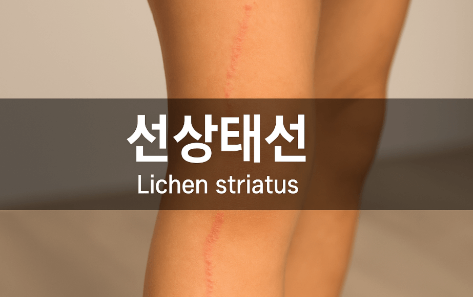 선상태선 증상
