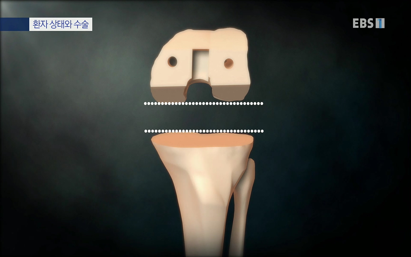 EBS 명의 헬스케어 - TV - 교육의 중심 EBS무릎 건강 프로젝트 2부 새 무릎으로 사는 법 .mp4_20220726_202329.233.jpg