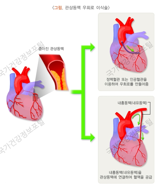 관상동맥우회술