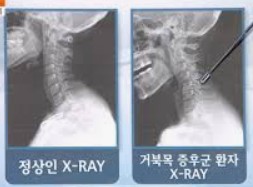 거북목