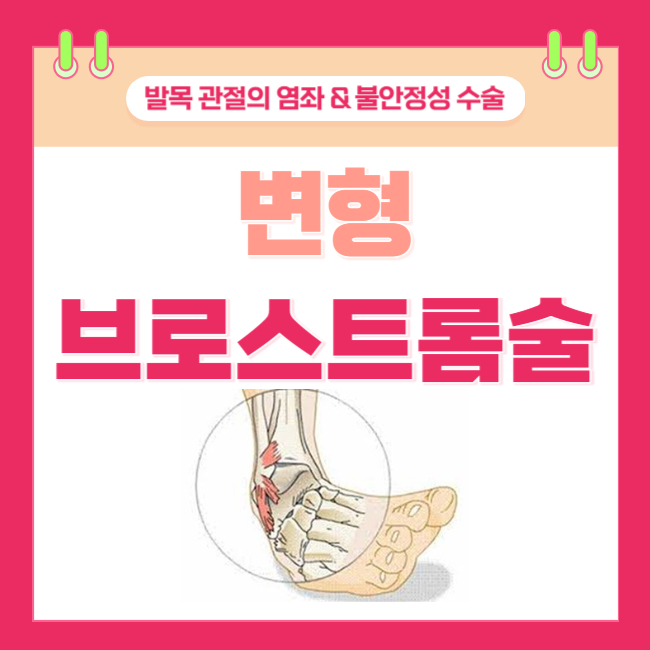  발목 관절의 염좌 및 불안정성 수술 <MBO; 변형 브로스트롬 수술>
