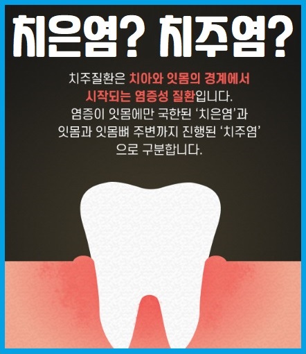 치은염 치주염