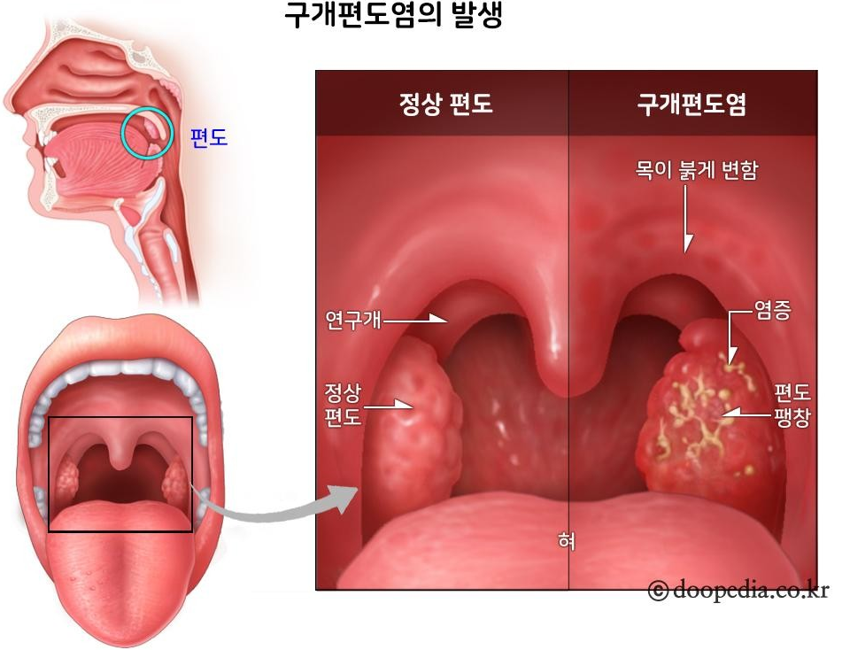 편도결석