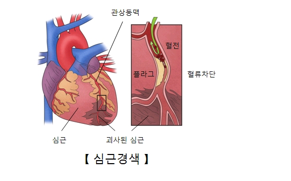  개그맨 임준혁 심근경색증 원인 초기 증상, 예방, 좋은 음식