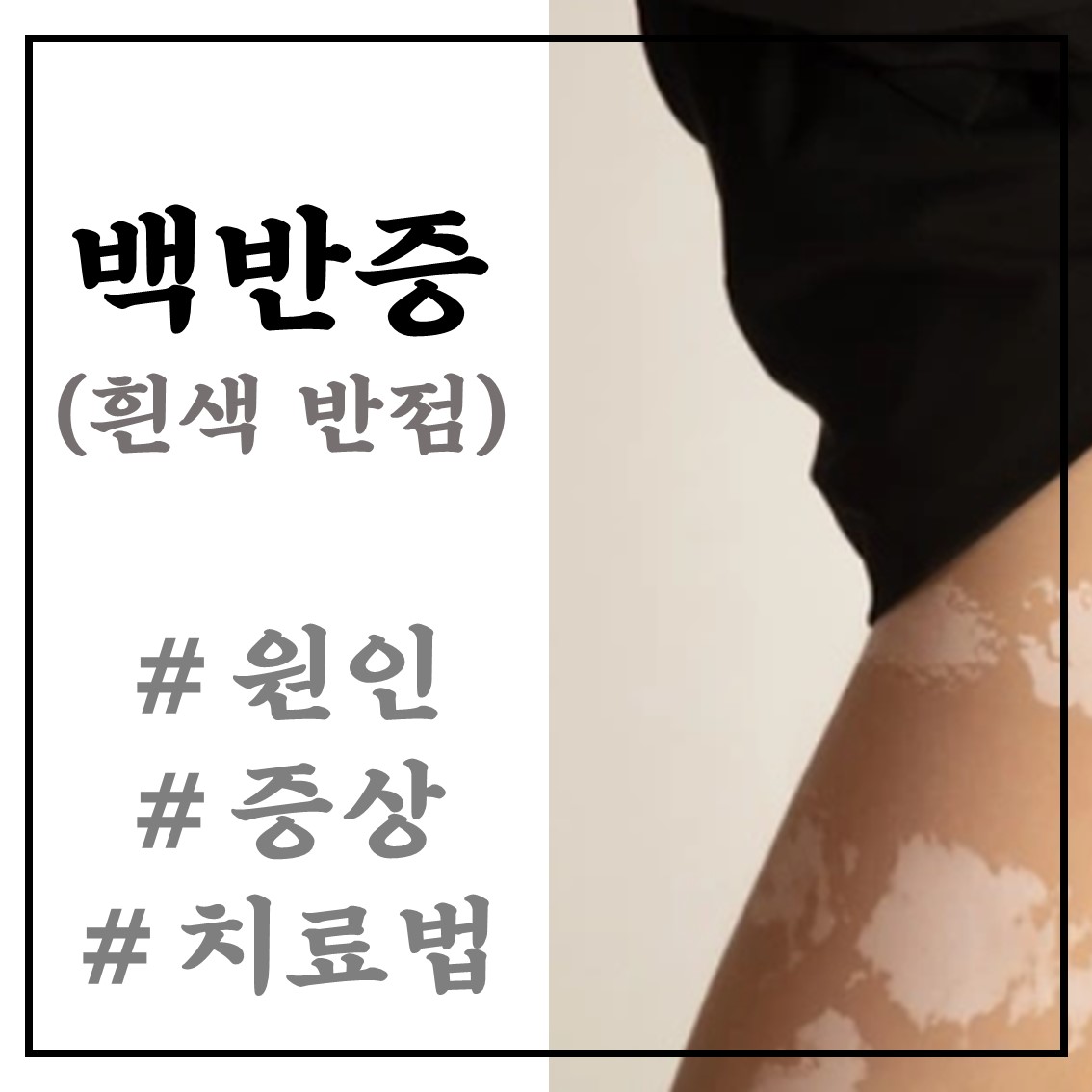  백반증 원인 증상 치료방법 정리