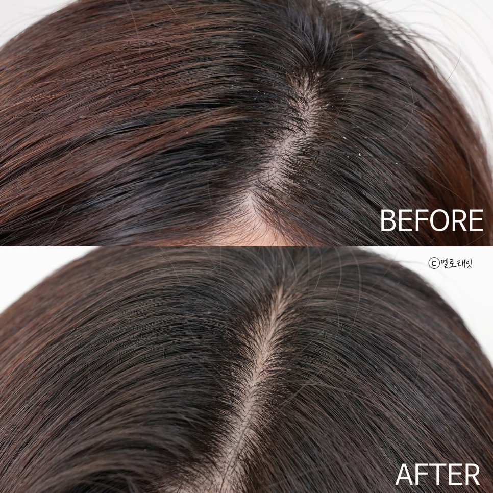 ts 탈모샴푸 이번엔 6