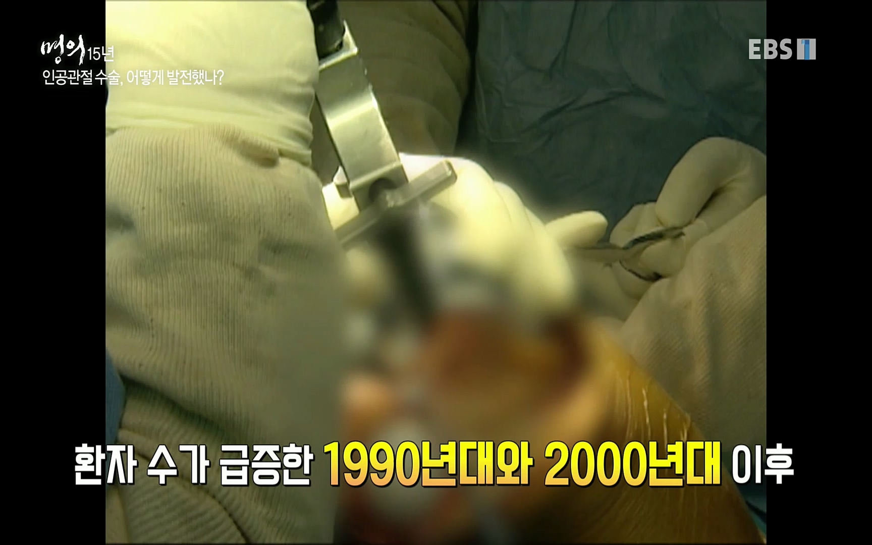 EBS 명의 헬스케어 - TV - 교육의 중심 EBS명의 15년 - 퇴행성관절염, 다시 걷는 사람들.mp4_20220803_212701.626.jpg