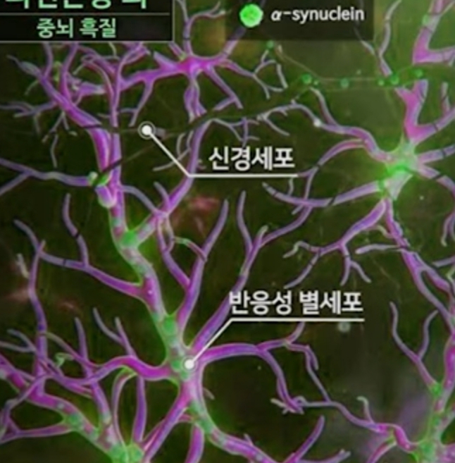  파병:뇌
