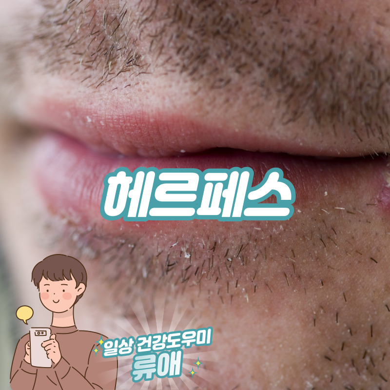 헤르페스 증상 및 원인, 치료 1