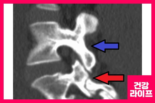 뼈 조각을 척추 뒤쪽에 이식하여 치유하고 융합하는 척추 융합