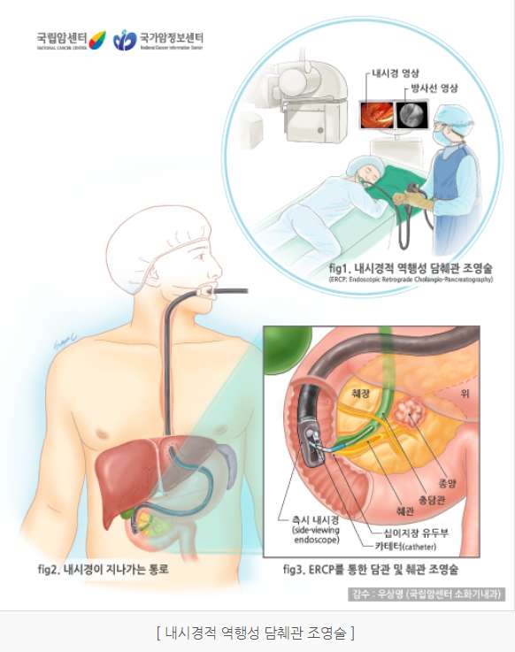 췌장암