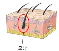 모낭염