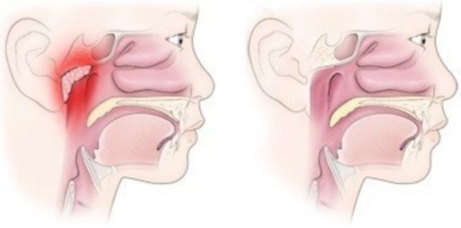 아데노이드 수술 아데노이드 비대증과 편도 비대