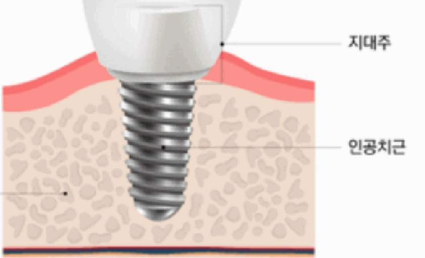 임플란트 시술 과정 사진