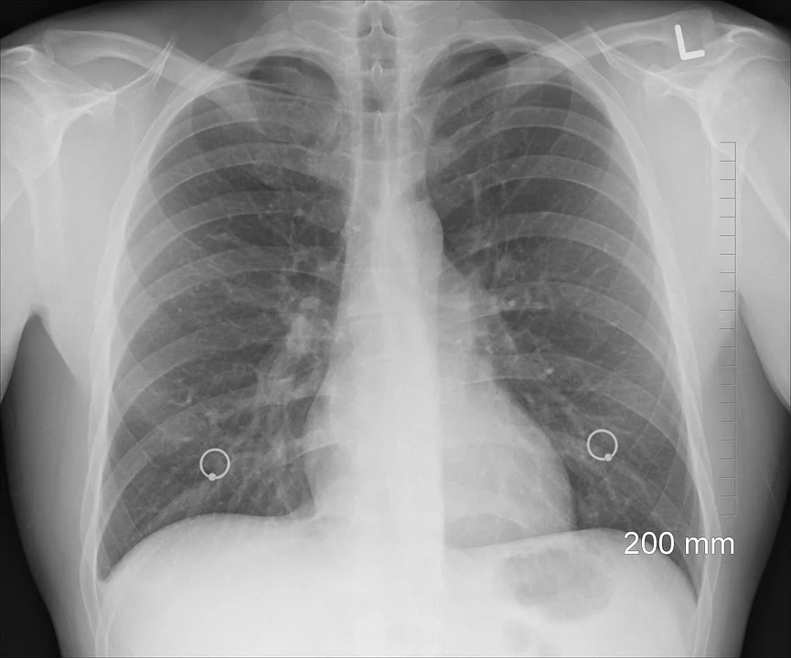 폐에 기저질환이 폐암으로 발전할 가능성도 있다.