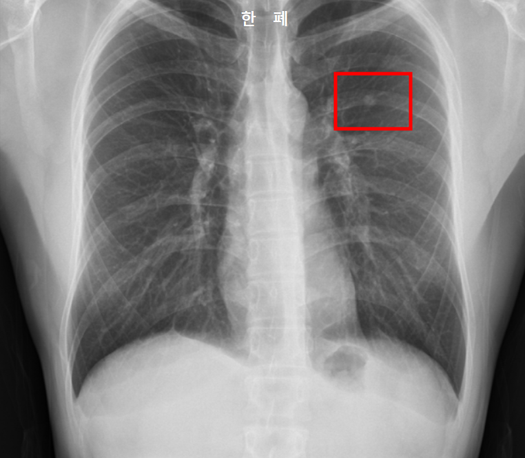 폐 결절 자라는 속도 X-ray 사진